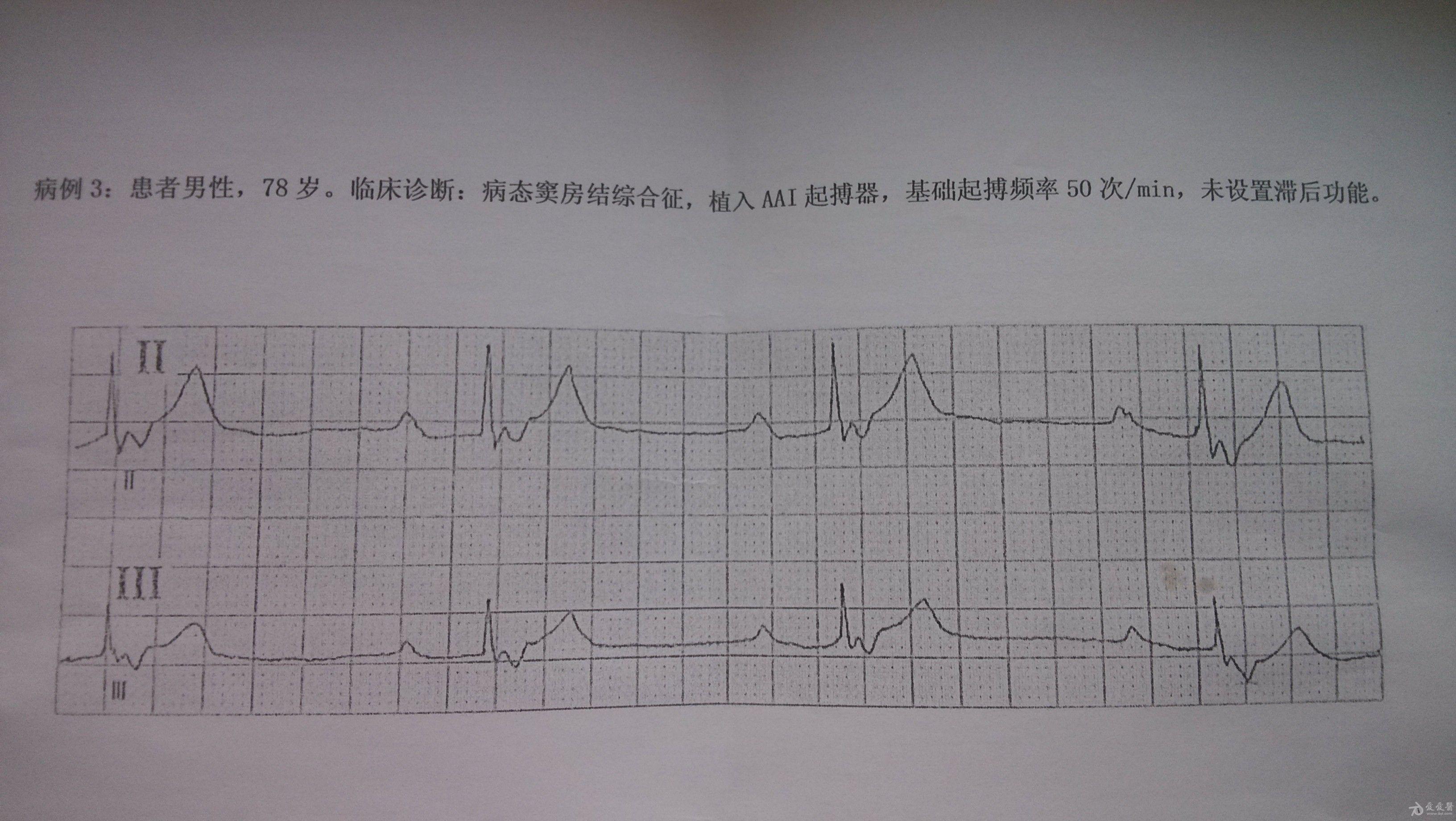 请教一下这四例起搏器心电图