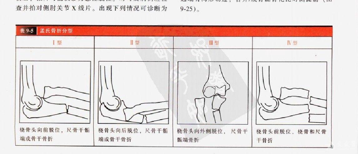 骨科群内病例尺骨近端桡骨小头骨折