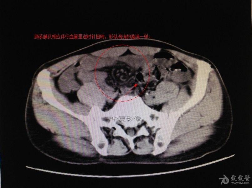 急腹症ct表现肠扭转