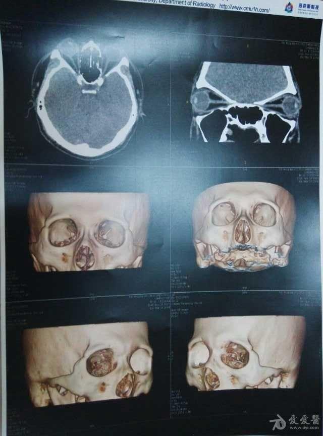 左侧眼眶内壁骨折伴左侧筛窦内积血积液,求指点