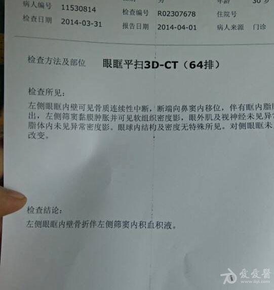 左侧眼眶内壁骨折伴左侧筛窦内积血积液求指点