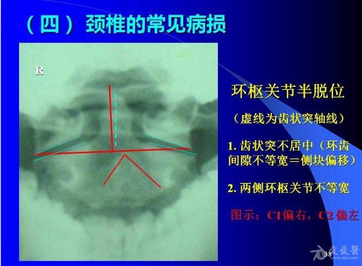 颈椎阅片