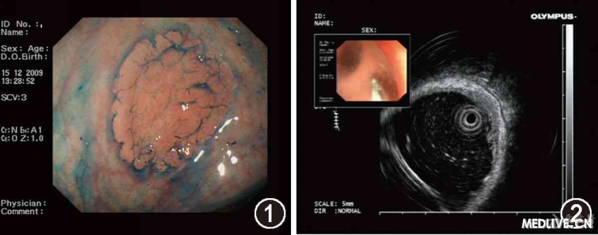 分享直肠胃黏膜异位1例