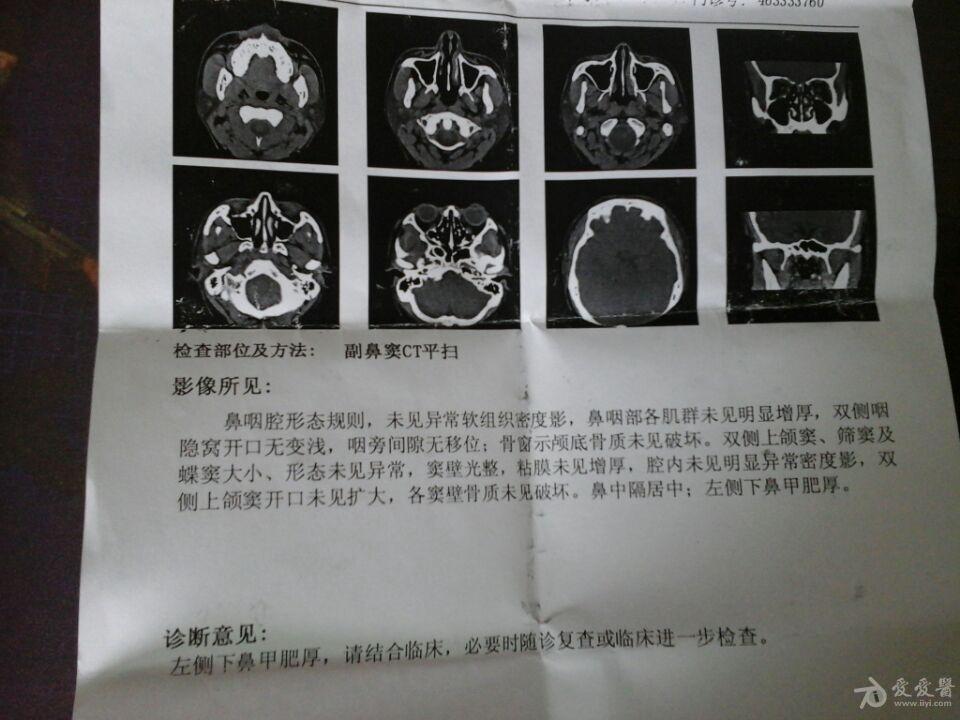 副鼻窦ct平扫