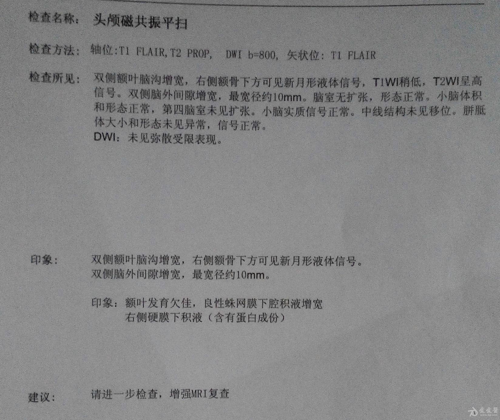 核磁共振的结果请各位大夫帮我请一下跪谢