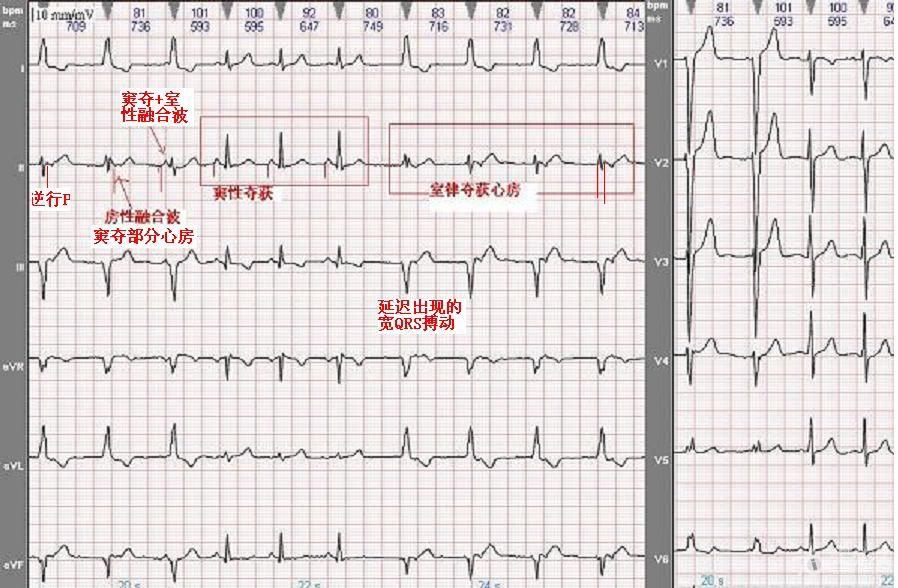 请各位老师帮忙看看这是室性早搏,还是交界性早搏