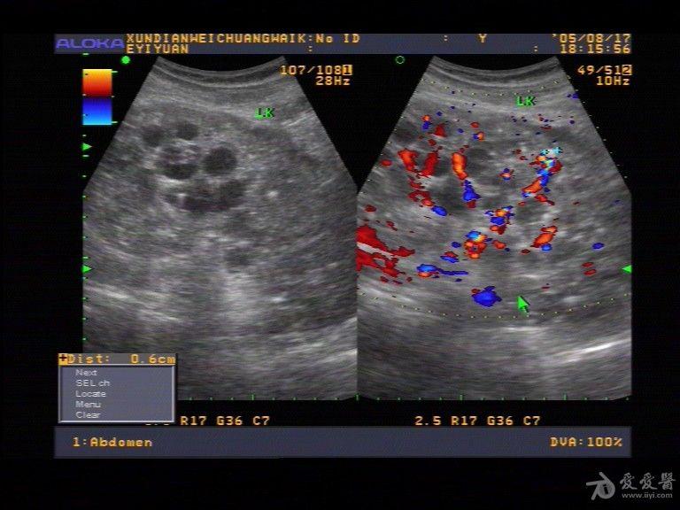 论坛 69★临床检查区 69 超声医学讨论版 69 多囊肾,膀胱里