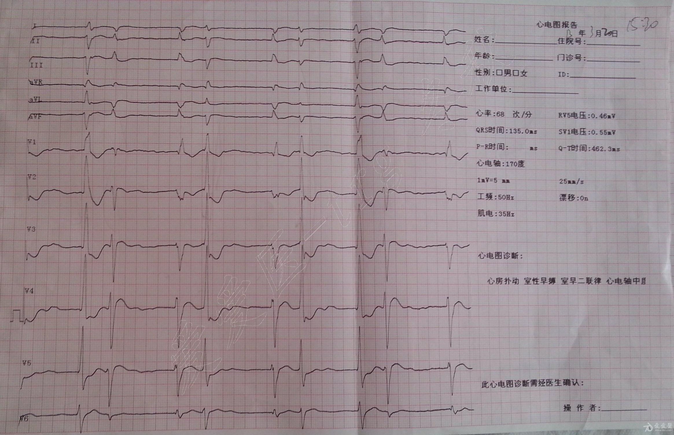 冬秋心电图讨论20140426房颤