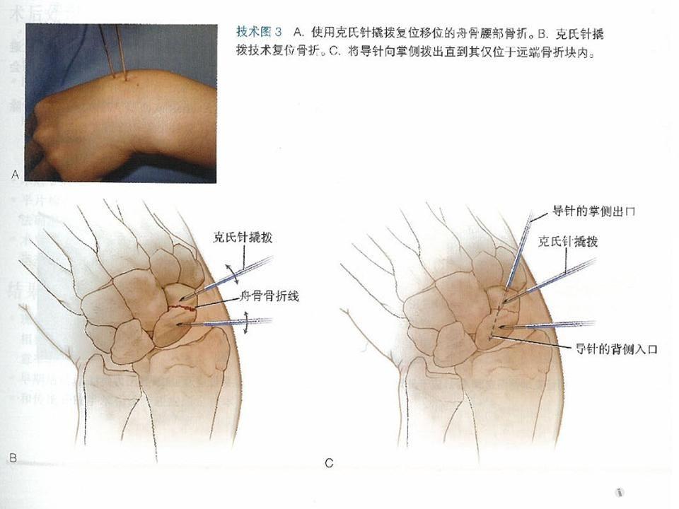 经皮螺钉固定腕舟骨骨折