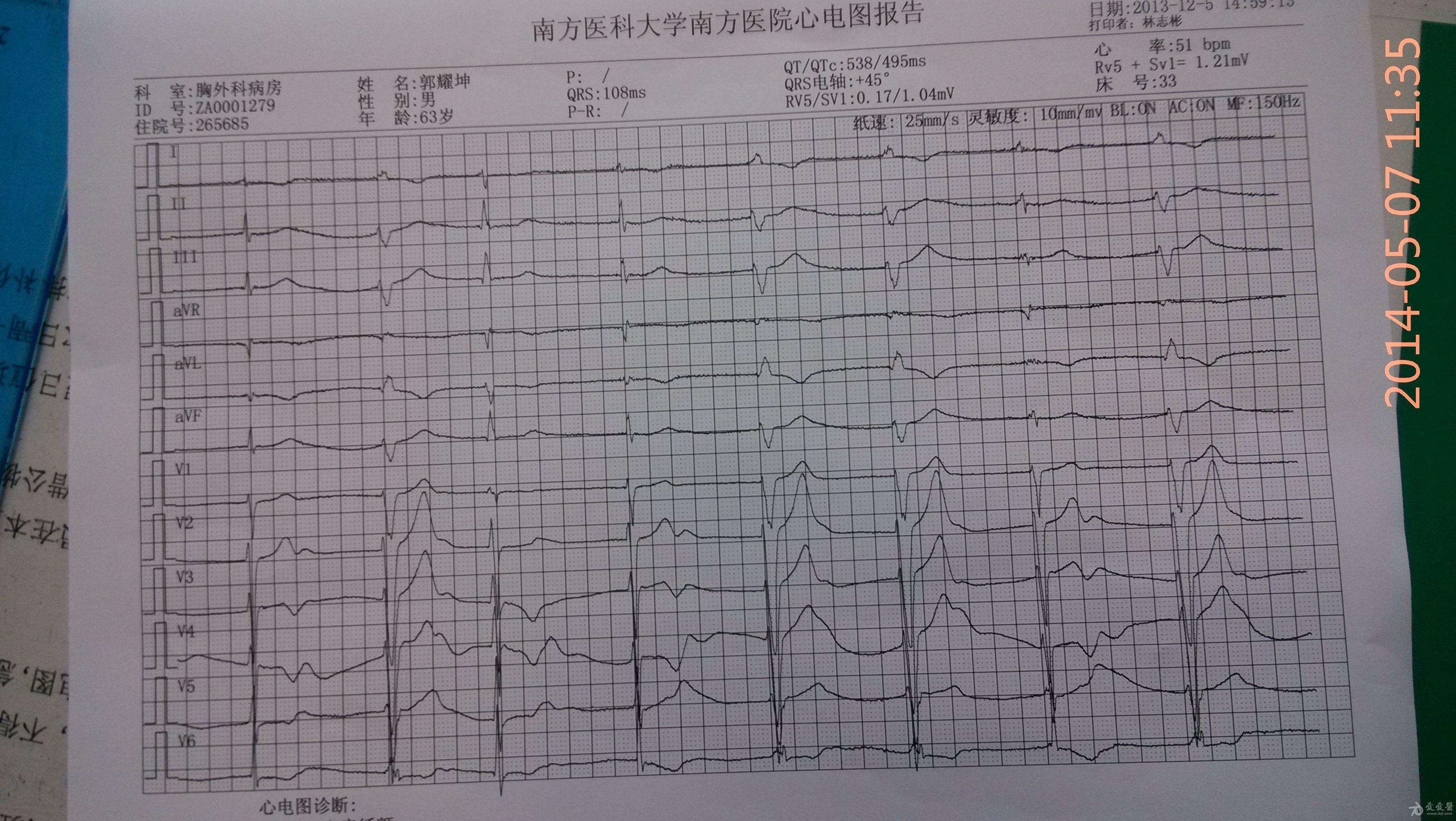 房颤高度室性逸搏大家觉得是吗