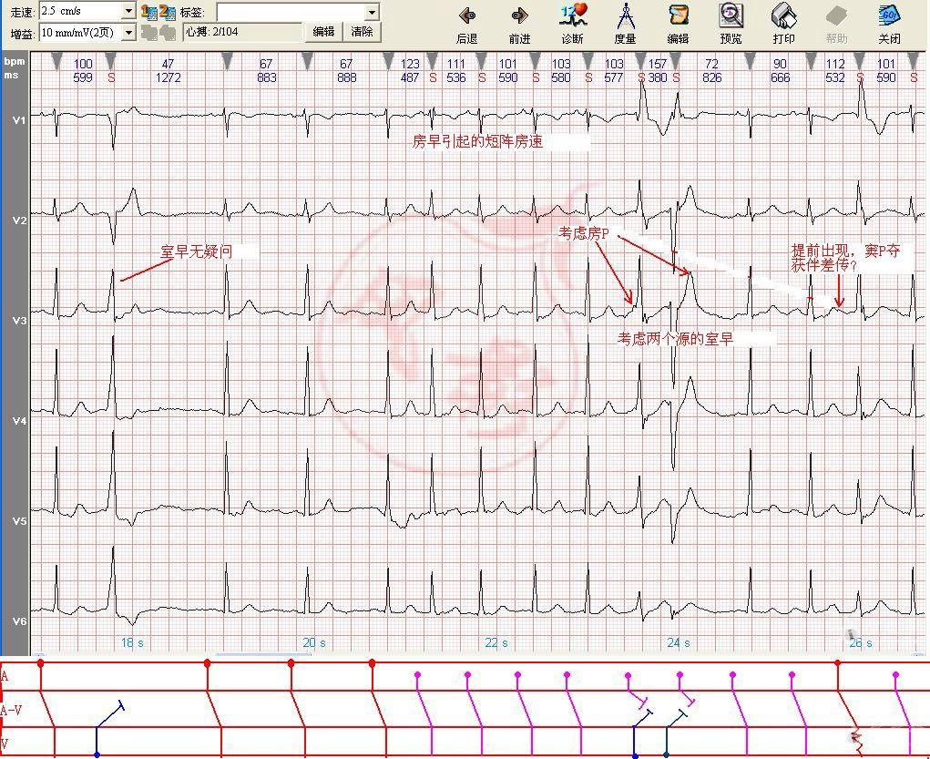 心电图学习20140506