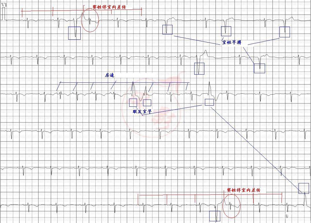 心电图学习20140506