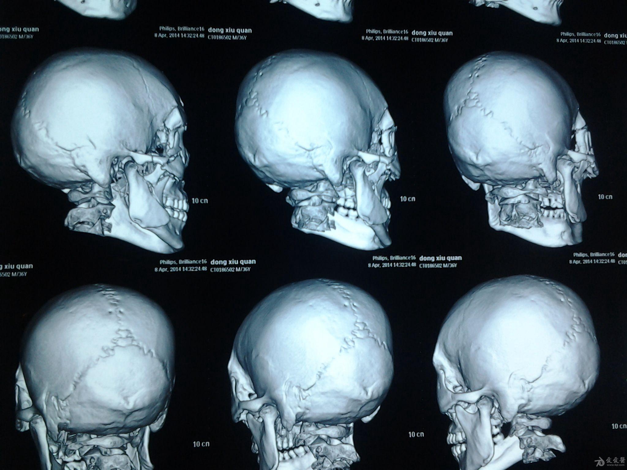 面颅骨复杂性骨折?求意见