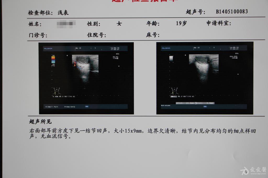皮脂腺囊肿手术一例