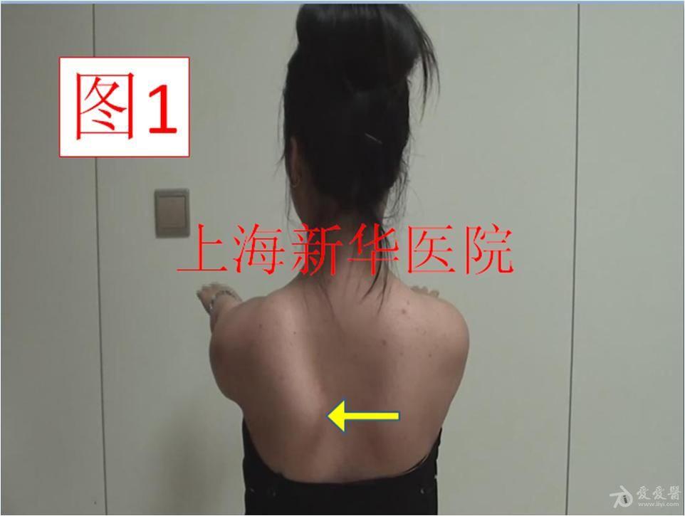 翼状肩胛典型病例