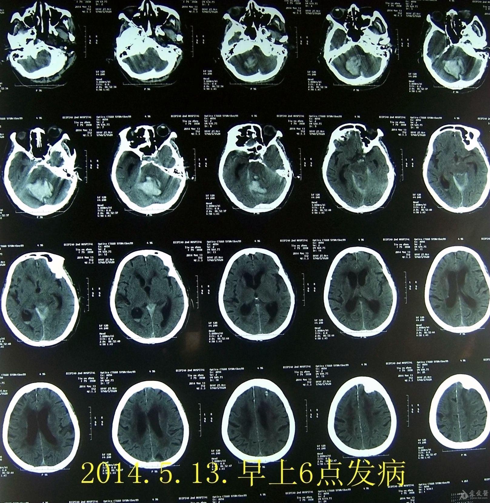 ct下微创穿刺治疗小脑出血