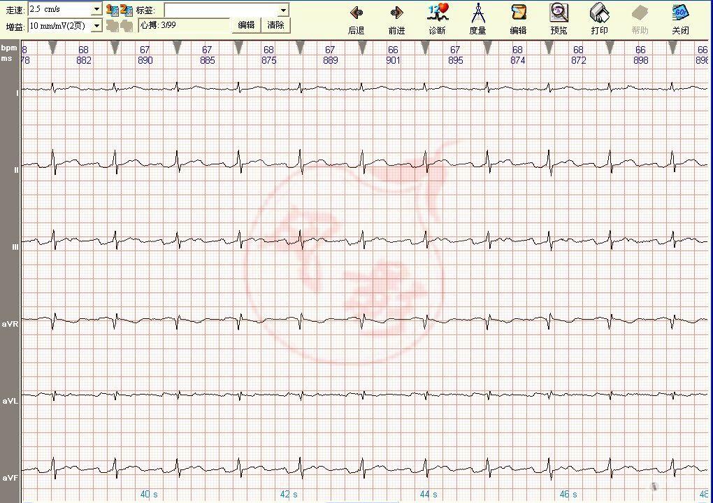 心电图读图第33期(参考答案已公布)