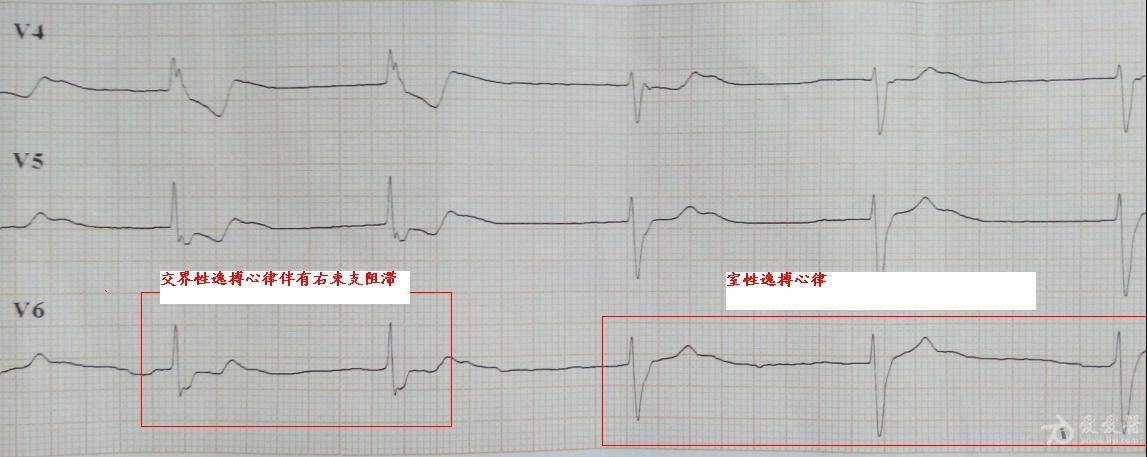 老师来看看,是室性逸博吗