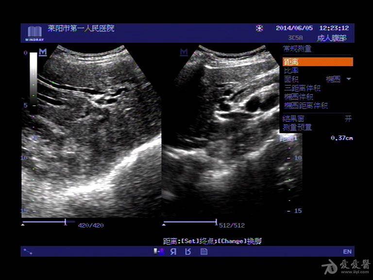 超声入门贴372-壶腹癌