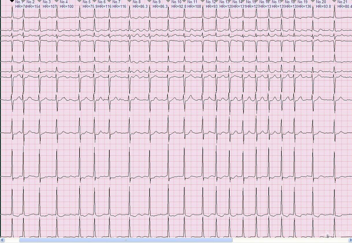 转心电图来遇到的第一个房颤,留念!
