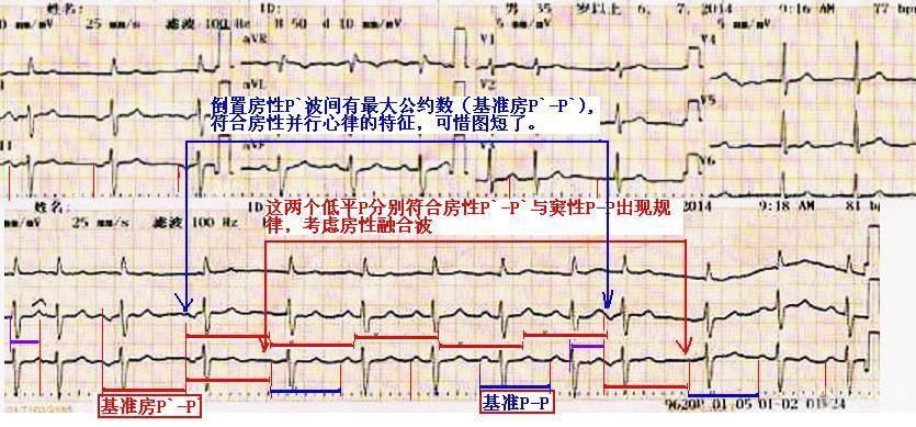 发尖风-房早-房性并行心律图-4.jpg