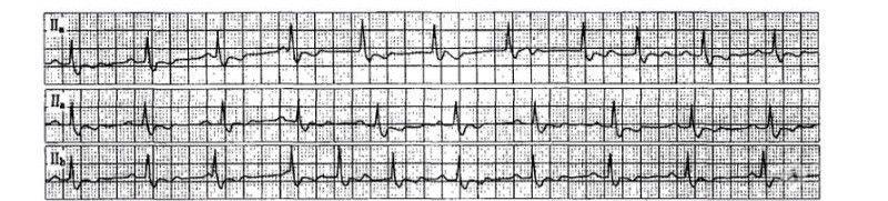 请各位老师分析心电图是房