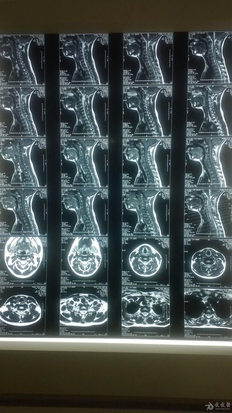 14岁小孩颈椎区疼痛,做了颈胸腰mri