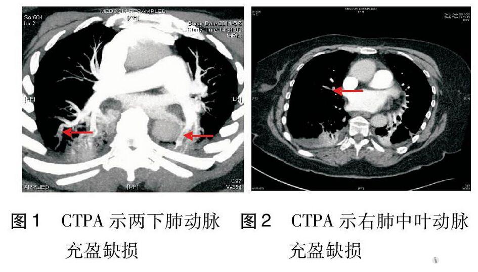 是否能诊断为肺栓塞?