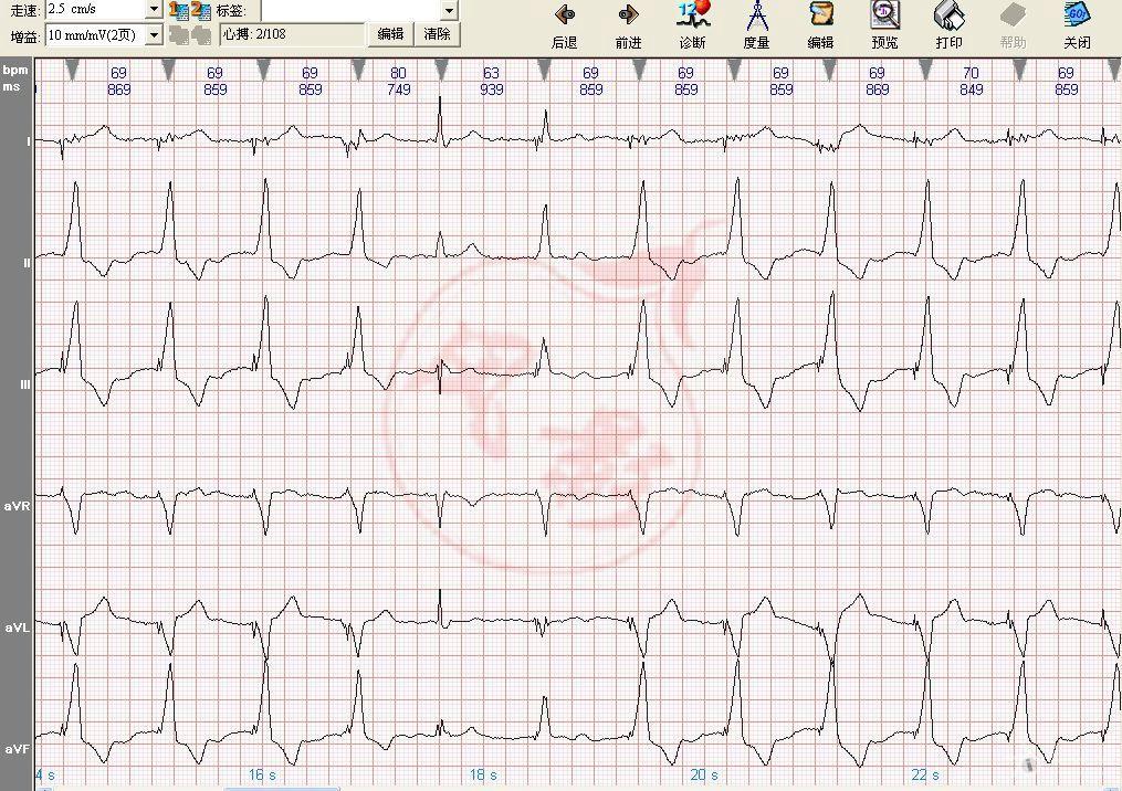 心电图学习20140615 起搏心电图