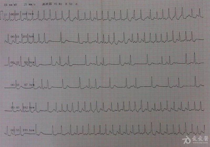 阵发性房颤 - 心电图脑电图专业讨论版 - 爱爱医医学