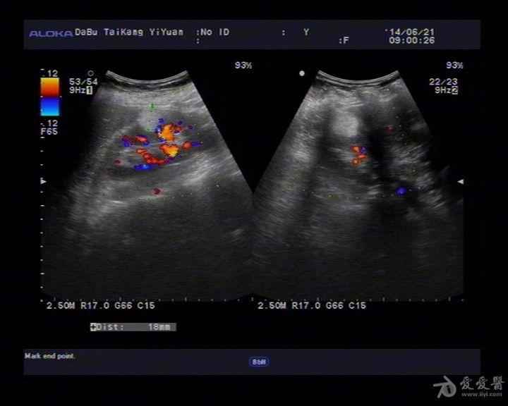 右肾错构瘤? - 超声医学讨论版 - 爱爱医医学论坛