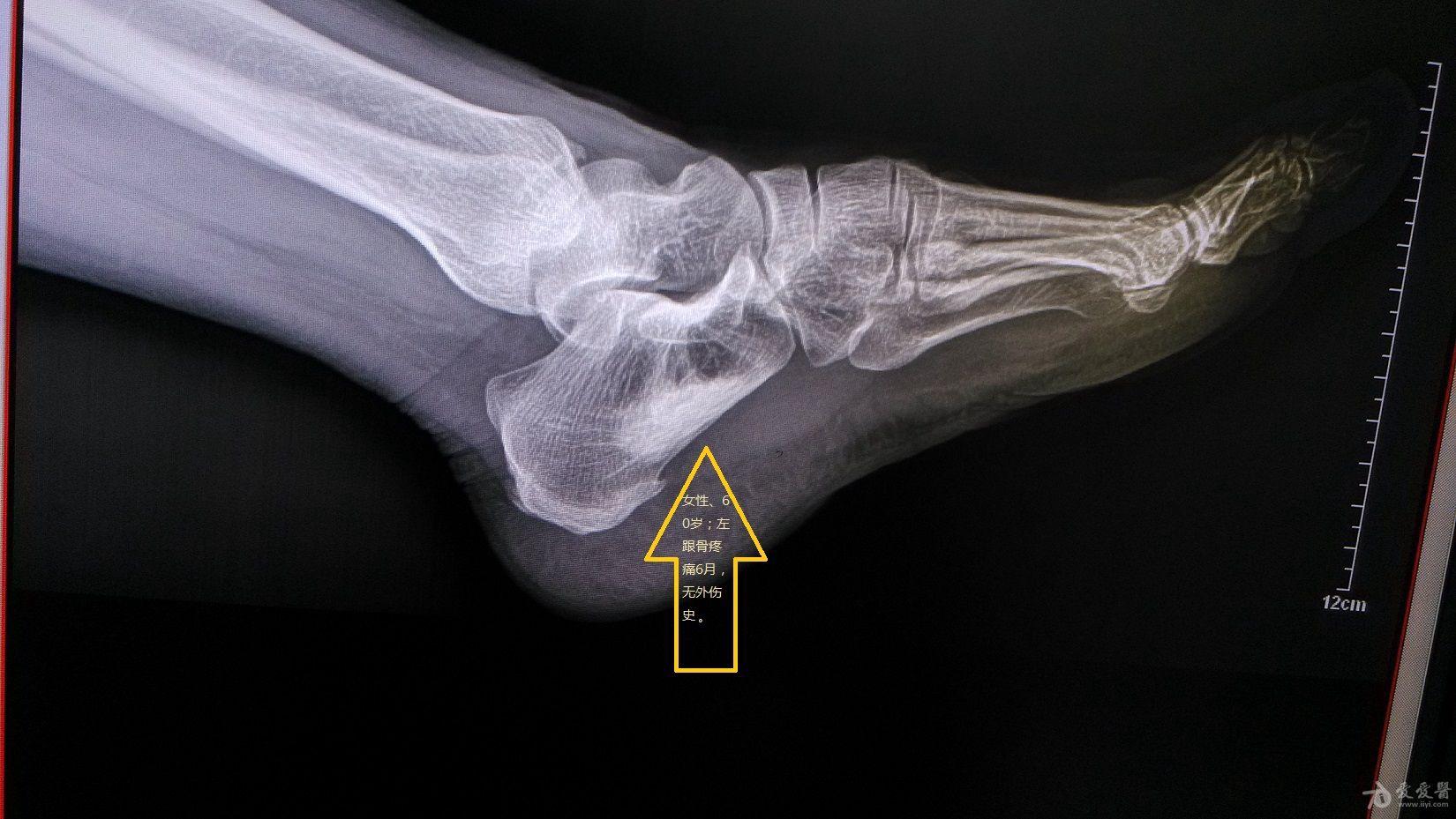 女性60岁左跟骨疼痛6月无外伤史摄片如下