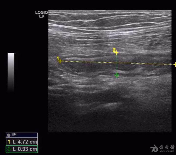 阑尾炎声像图 - 超声医学讨论版 - 爱爱医医学论坛