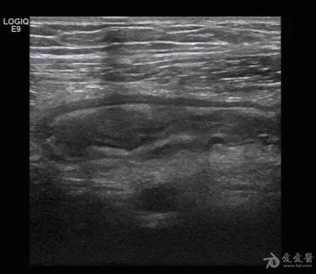 阑尾炎声像图 - 超声医学讨论版 - 爱爱医医学论坛