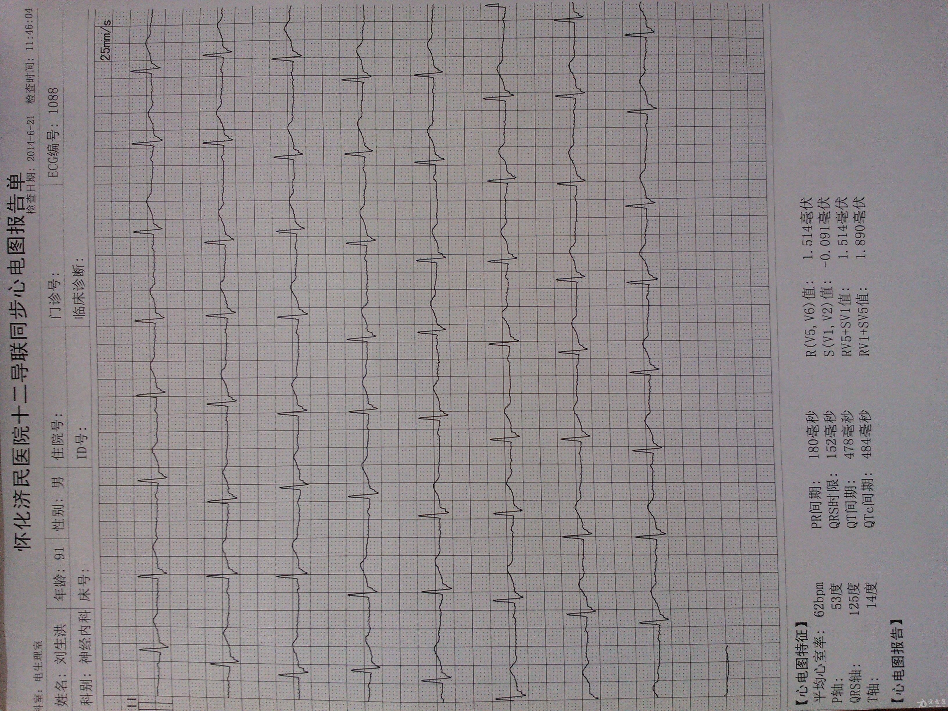 这是同一个患者的标2导联的心电图