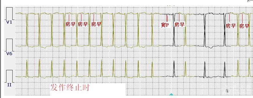 山羊老师:这是房速吗? - 心电图脑电图专业讨论版