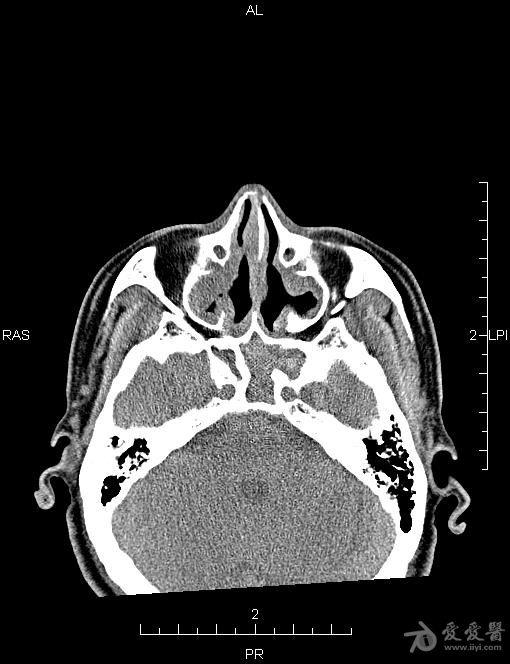 鼻窦ct