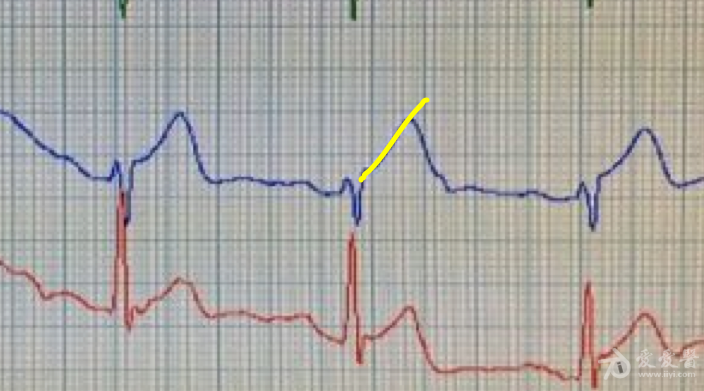 前间壁r波递增不足和超急性前间壁心肌梗死? - 心电图