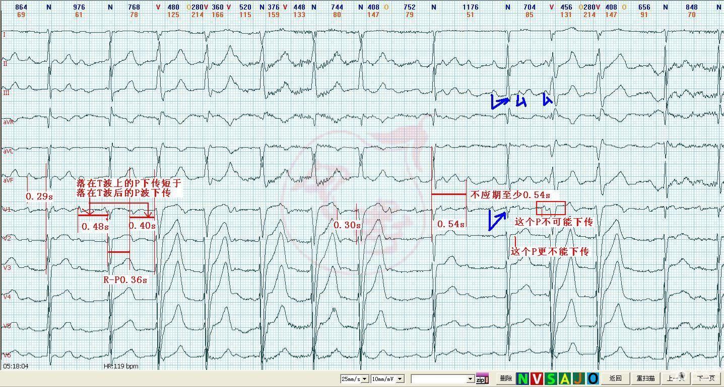 心电图读图第33期-动态心电图-5-2-落在t波上的p-r短于落在t波后的p-r