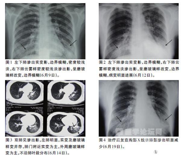 支原体肺炎的影像学特征