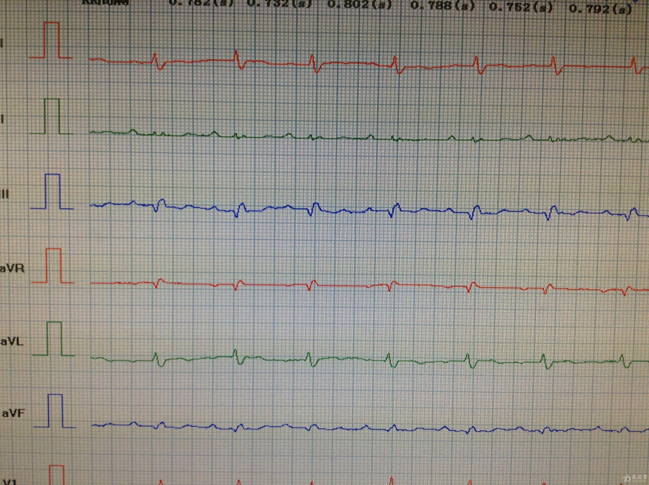 心电图脑电图专业讨论版 - 爱爱医