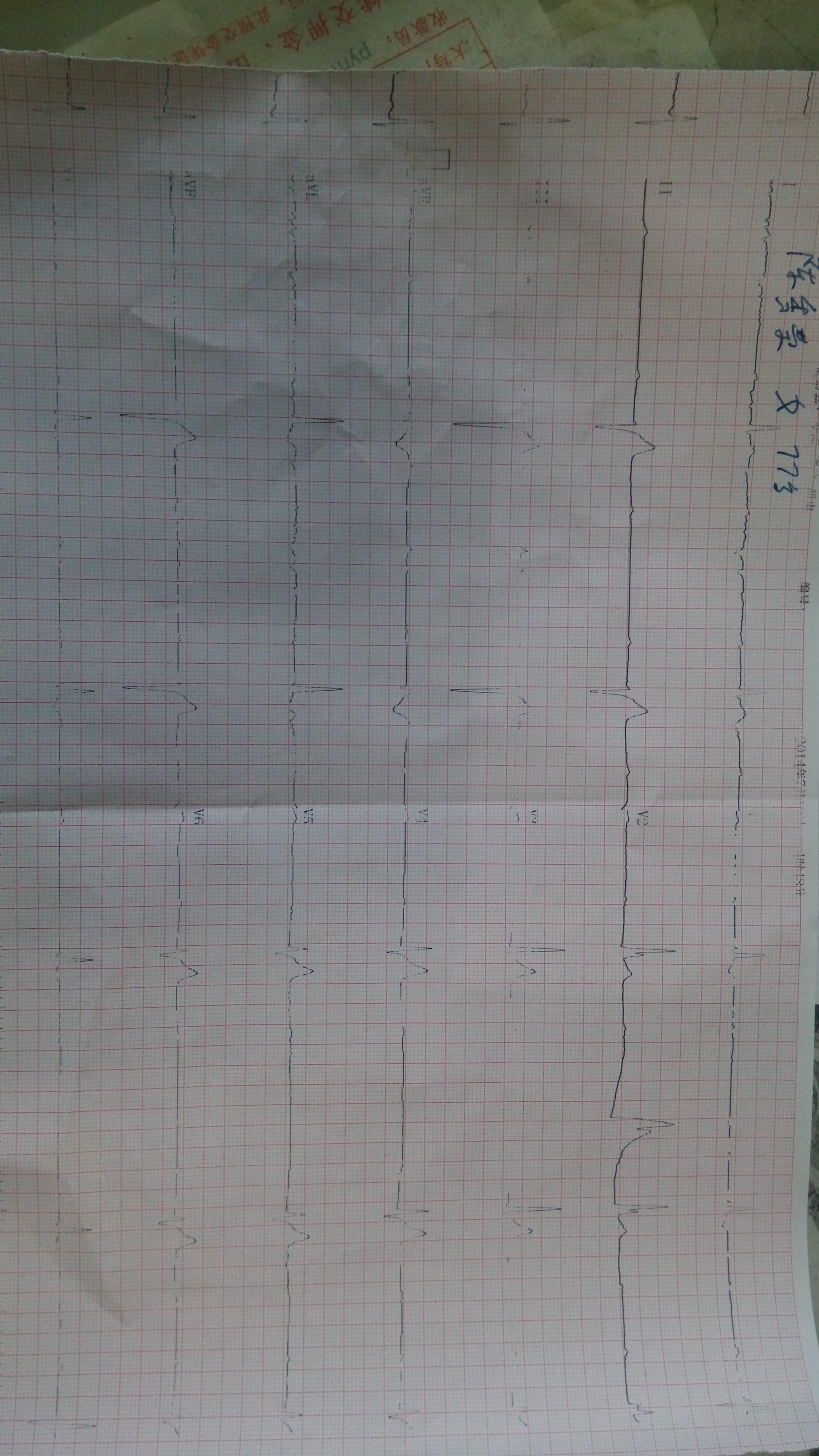 这是逸搏心律还是三度传导阻滞 心电图脑电图专