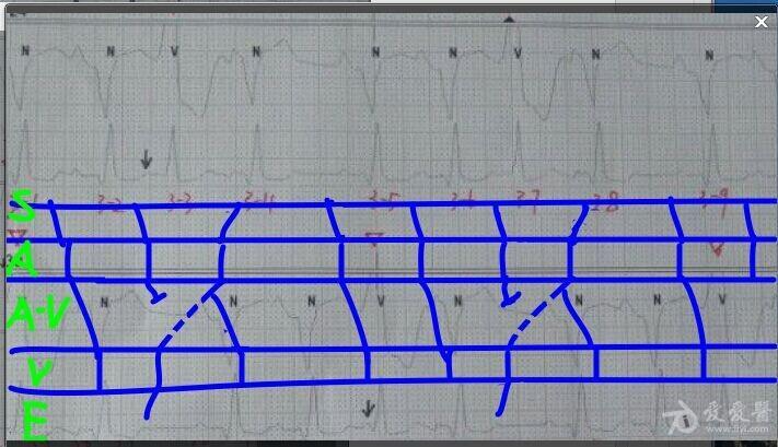 如何学好心电图千奇百怪的室性早搏