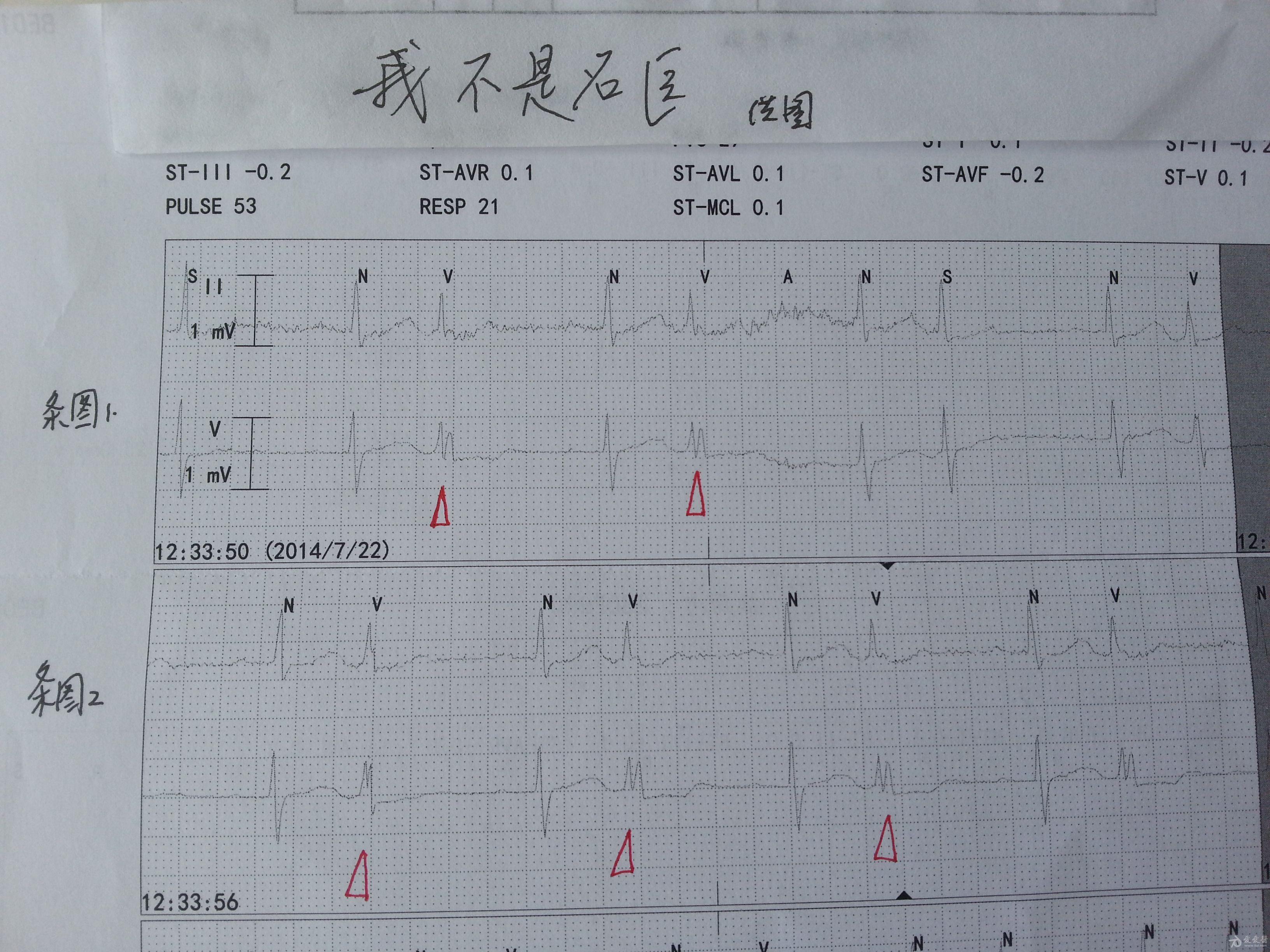 【心电图实践学习】ccu监护心电图,请您出报告