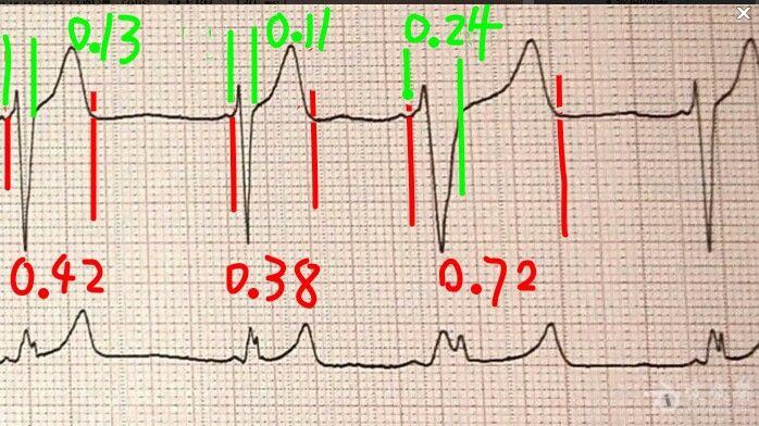 冬秋心电图讨论20140722宽qrs波如何解释