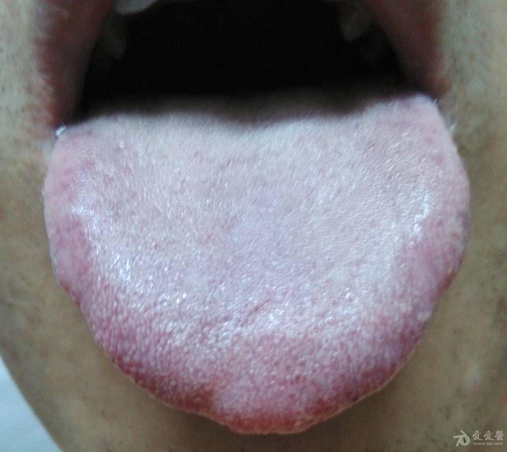 把舌象发上来  麻烦您看下,这是我的舌象图片