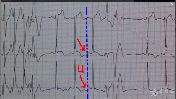 平板运动过程出现的心电图