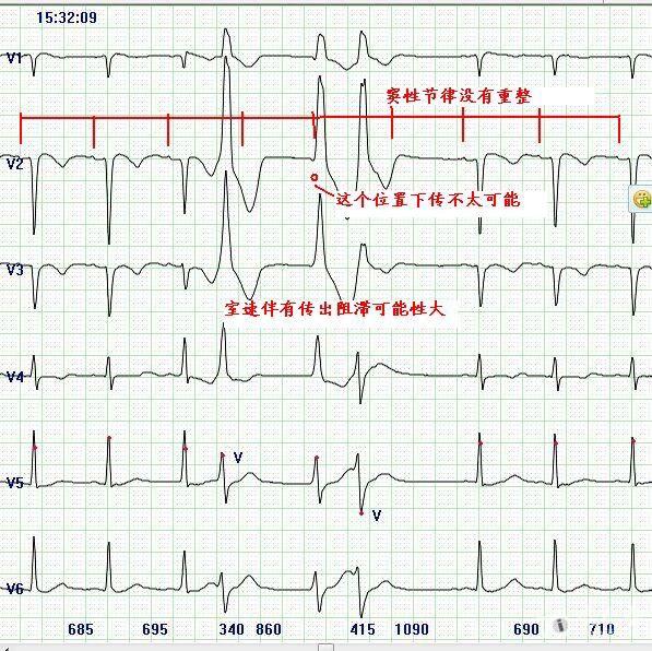 长间歇后连续出现的两个宽qrs怎么解释好--.jpg