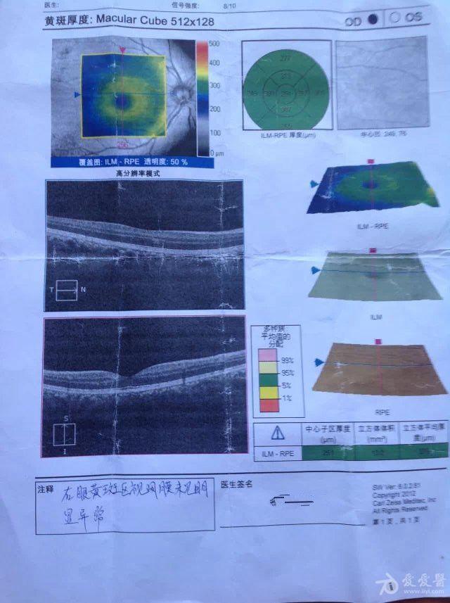 这个是3月份的oct,没有异常.