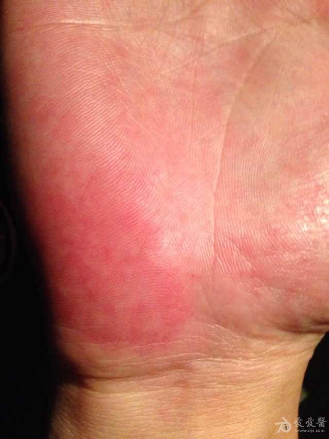 男性,38岁,于两个月前双侧手掌出现红斑,不痛不痒,无水疱.